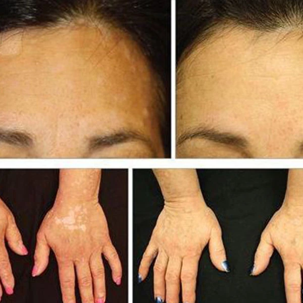 Tofacitinib treatment for vitiligo Tofacitinib treatment for vitiligo
