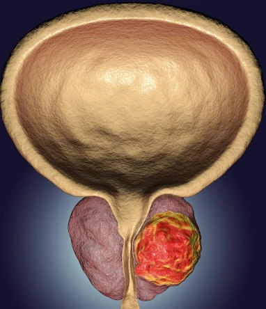 How long can prostate cancer survive after bone metastasis? How long can prostate cancer survive after bone metastasis?